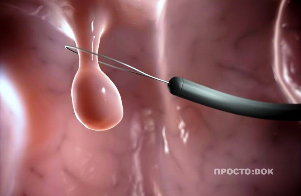 Нужно ли удалять полипы матки?